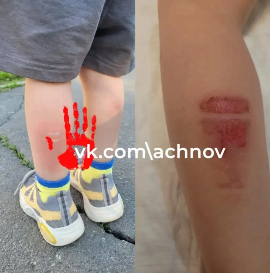 Во время короткой поездки 18 мая трёхлетний мальчик обжёг ногу о радиатор в автобусе №2. Следователи возбудили уголовное дело об оказании небезопасных услуг и затребовали документы у перевозчика.