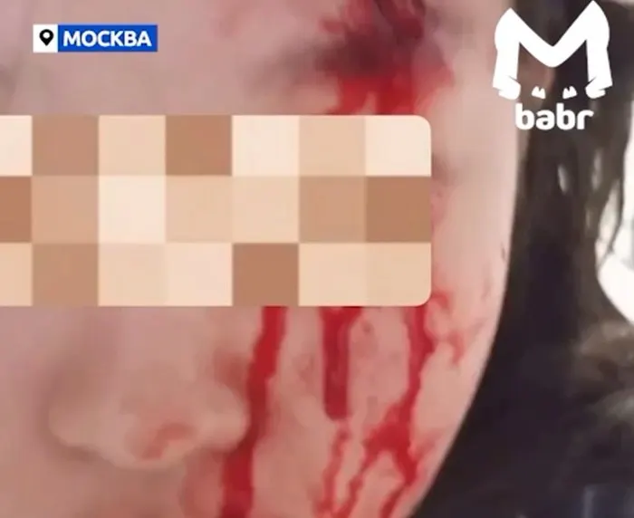 В Новой Москве проводится проверка после заявления об избиении подростка: у девочки сотрясение, рассечена бровь и наложено пять швов. Заявление поступило 26 мая в ОМВД «Коммунарский».