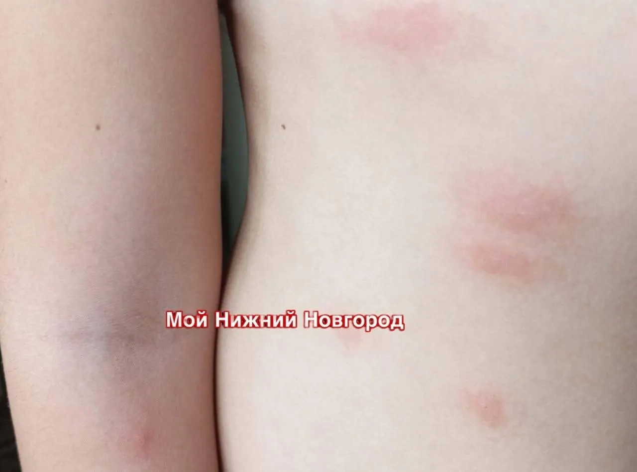Жители сообщают о сильном зуде и сыпи после купания в Светлоярском озере. Роспотребнадзор подтвердил, что купание пока разрешено, но информацию передали в комитет ветеринарии — при подтверждении загрязнения купание запретят.
