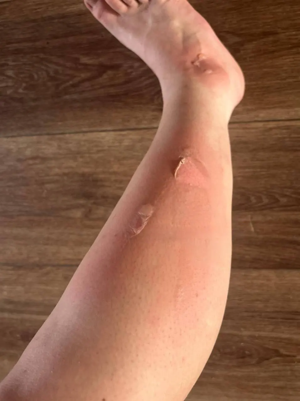 В автобусе №24 отключили кондиционер, но работали нижние обогреватели — женщина упала на раскалённые элементы и с ожогами госпитализирована; аптечки в салоне не оказалось.