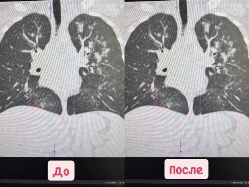История пациента в регионе иллюстрирует риски вейпинга и важность своевременной медицинской помощи.